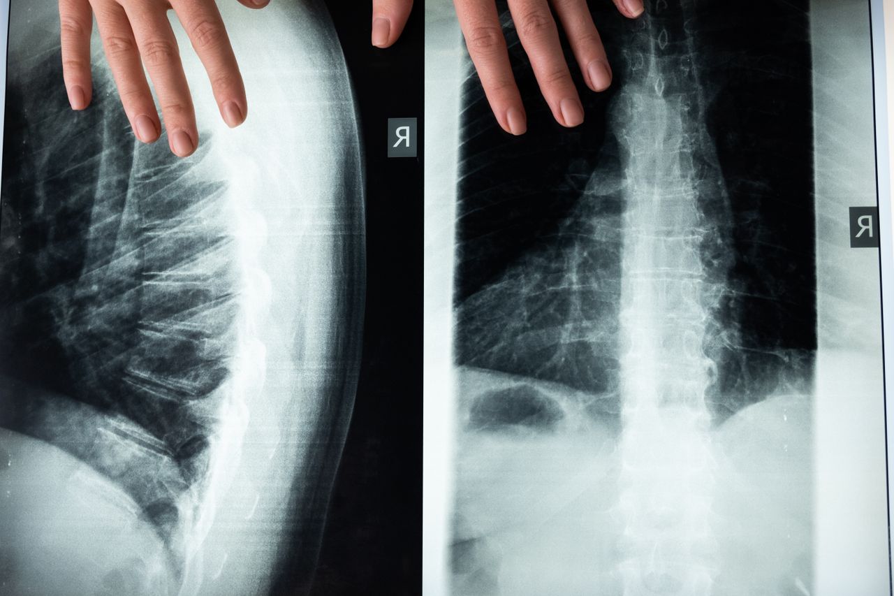 Unstable Spinal Fractures During International Medical Repatriation